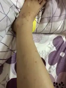  去海南玩了几天,被海边的蚊子咬了,刚开始是红点,没当回事,回来两