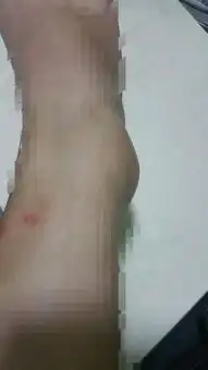  这被蚊子咬到骨头了,怎么肿了这么一个大包,怎么回事,是蚊子有毒吗