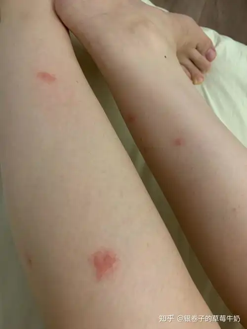  为什么我被蚊子咬了之后那个小包会越来越大像那一块肿了一样