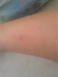  身上长这种红疙瘩挺像被蚊子叮的但不是求解释