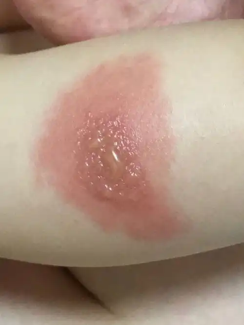  秋老虎厉害秋蚊子咬人更狠毒,小伙子被蚊子叮咬后过敏,全身长满红色小疙瘩