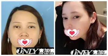  合肥壹加壹双眼皮隆鼻谁做的好孟松甘泉涌及王大勇等医生真人案例及价格公布