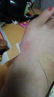  蚊子咬后,变成了水泡,好大一个,怎么办,是什么情况