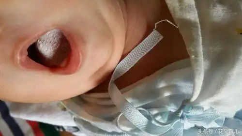  鹅口疮到底需要怎么治疗用朱氏青梅散有效吗