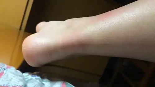  短短3天,腿烂了杭州一小伙踩了水坑,竟进了医院
