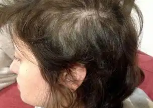  女子患拔毛狂躁症15年,拔头发现拔成斑秃
