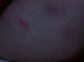  冬天小孩小腿腰间长一些像蚊子咬的包包是什么