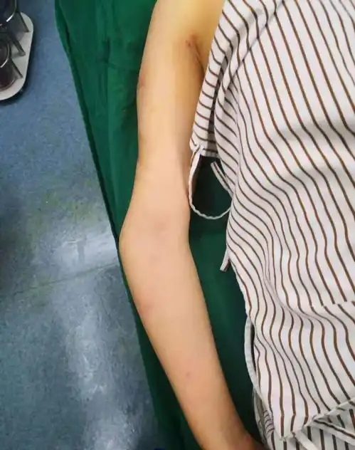  小时摔伤致肘内翻畸形,矫形术小切口恢复正常