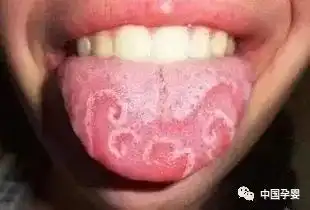  爸妈怎么从宝宝舌头看病情