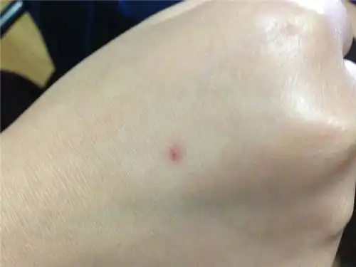  为什么有的人被蚊子咬后起一个大包,有的人则是出现一个红点