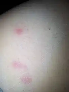 腿上长像蚊子叮的包