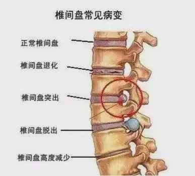 从躺平到腰椎警报,这份腰突自救指南请收好  从躺平到腰椎警报,这份腰突自救指南请收好