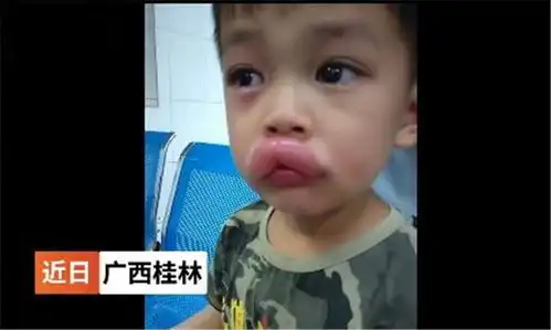  不好笑男孩吃葡萄过敏肿成嘟嘟嘴,婴幼儿食物过敏不是小事