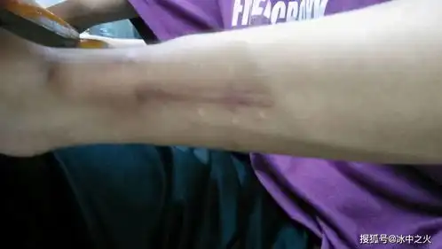  每年征兵体检时,为何身上有伤疤的人不能参军主要有三个原因