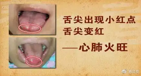  冬季容易上火,中医教你如何从舌头辨识上火根源