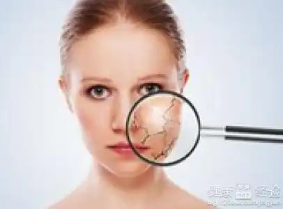  手肘神经性皮炎会脱皮吗