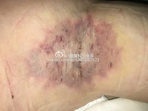  腋臭复发常见实例分析手术