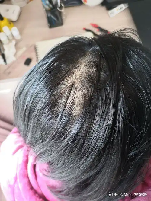 发旋稀疏,没头发,盖都盖不住的该怎么办