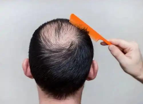  脱发是种痛干细胞移植真的能解决脱发之困吗