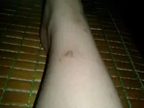  这是今年夏天蚊子叮伤的疤,挠了几天变成了深褐色,怎么去掉更快