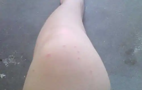  蚊子咬的红点多久会退被蚊子咬后最好能及时处理