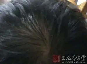  头癣的症状这些表现就是头癣