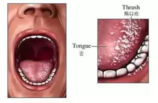  快看看孩子嘴里有没有这种白点,小心是鹅口疮