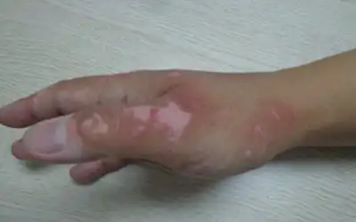  小孩手背长小白点图片