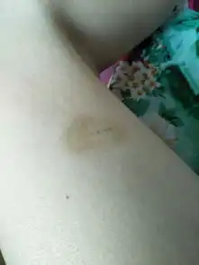  大腿被柯基抓伤了伤口好了但是周围却变青了