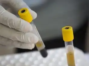  一次欢愉感染艾滋病若有这3个标志,八成是艾滋继承者
