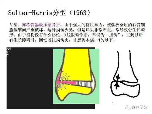  儿童骨骺损伤影像诊断