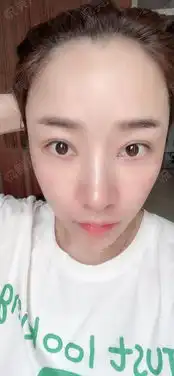  上个月去医院搞了皮肤,做了微针和激光,皮肤的确是好...隆鼻悦美整形