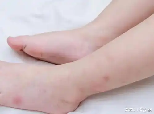  提醒蚊子最爱叮这两种人,究竟哪2种人看完涨知识了