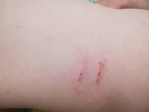 被猫咬了伤口肿就和被蚊子咬了一样