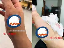 被排骨铡刀划伤手医院缝完血肉炸裂她吓傻po文引论战医师在救你
