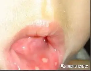 艾滋病鹅口疮