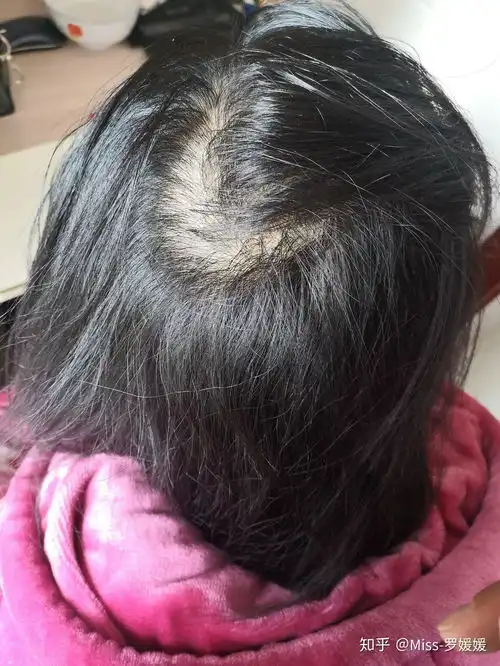  发旋稀疏,没头发,盖都盖不住的该怎么办