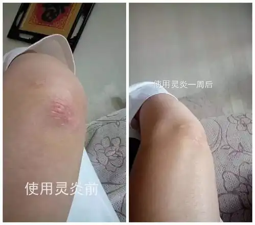 皮肤病牛皮癣湿疹蚊虫叮咬怎么办用这个方法试试看