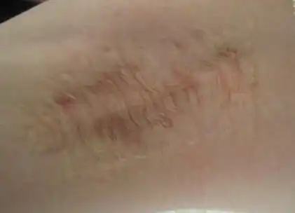  腋臭手术一般做哪个去腋臭的三种手术的详细介绍