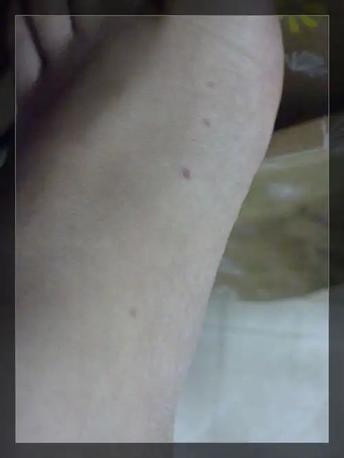  那被蚊子咬后不痛不痒,只是有个红点,是不是正常的啊