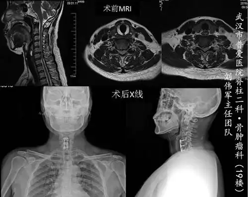 刘主任主刀,颈椎病患者前路手术展示  刘主任主刀,颈椎病患者前路手术展示