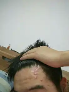  额头有伤疤今年征兵体检能通过吗有什么解决方案