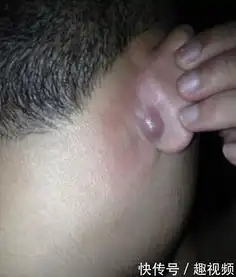  口腔感染是艾滋病的早期症状,遇到可疑hiv感染者如何处理