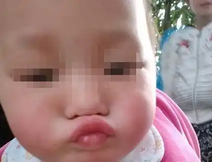  3岁女孩总嘟嘟嘴,奶奶察觉不对劲,医生的话让妈妈庆幸不已