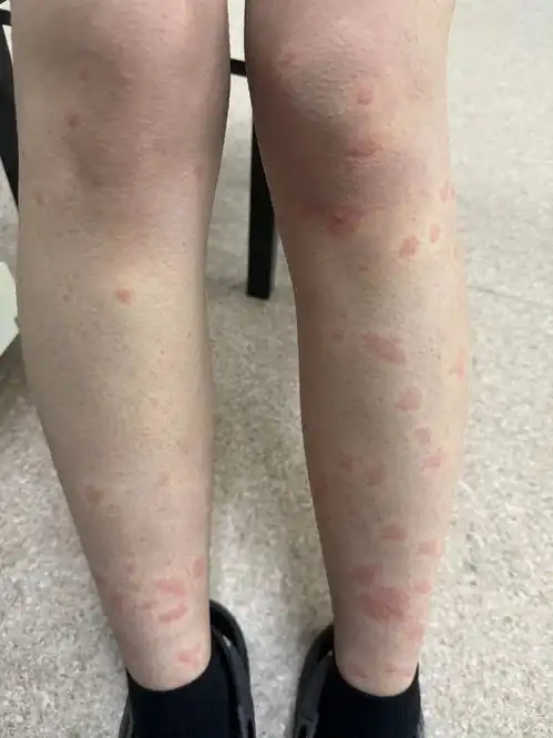  看不见有蚊子叮咬裸露的皮肤上却起了一个个包是怎么回事