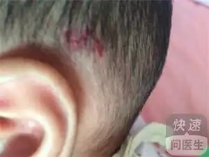 草莓状血管瘤为什么会出现感染情况