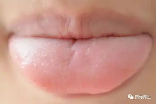  舌头上有这种表现说明你脾虚得治