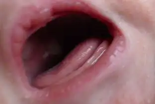  有经验的妈妈来看下宝宝口腔上颚里长的是鹅口疮还是口腔溃疡
