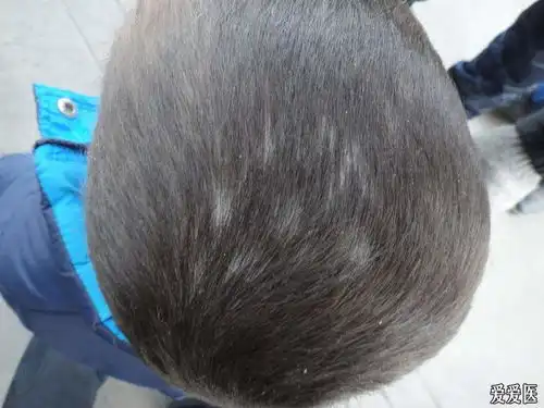  什么是头癣头癣分为哪几种怎样治疗头癣不复发