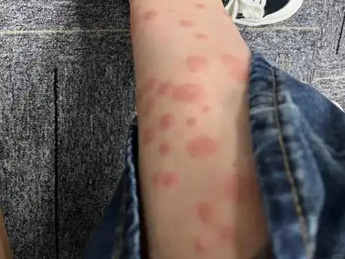  比蚊子还毒被咬后奇痒无比,长时间难以消退多人中招